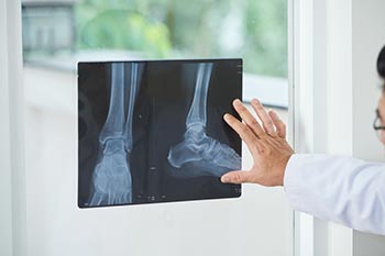 Ankle Fusion Surgery Miami Beach FL