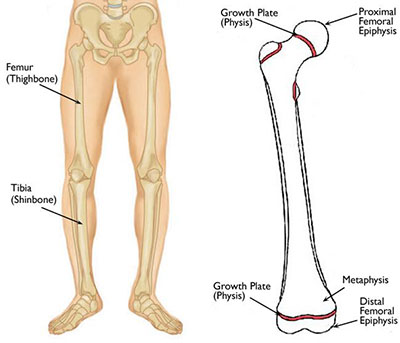 Leg Length Discrepancy