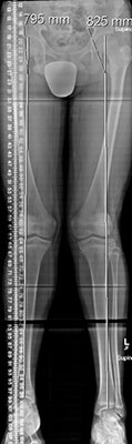 Leg Length Scanogram