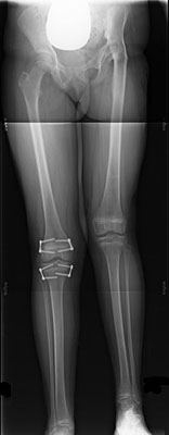 Lengthening of Femur